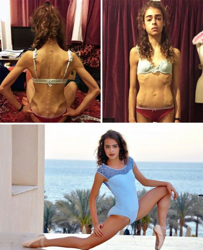 До и после Невероятные преображения людей поборовших анорексию