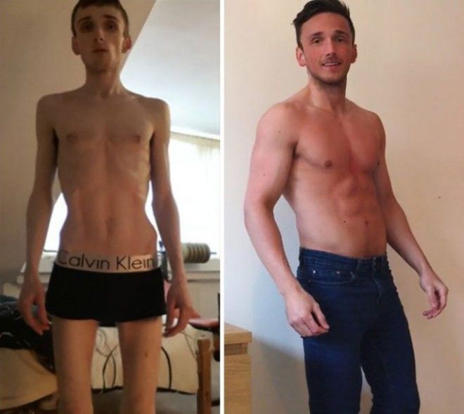 До и после Невероятные преображения людей поборовших анорексию