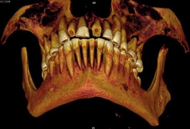 Следы древней стоматологии